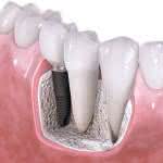 Implante dentário como é feito