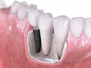 Implante Dentário Preço Médio