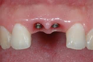 implante-dentario-sus2