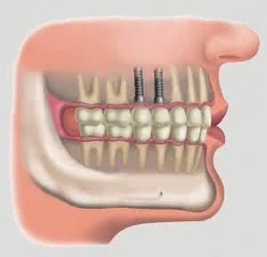 implante-dente