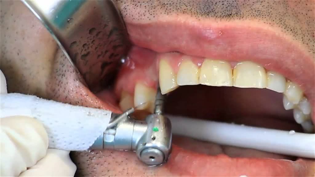 Como é Feito o Implante Dentario