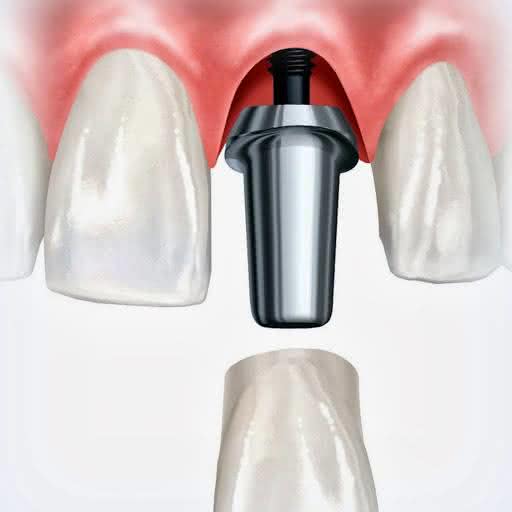 Implante Dentário Gratuito