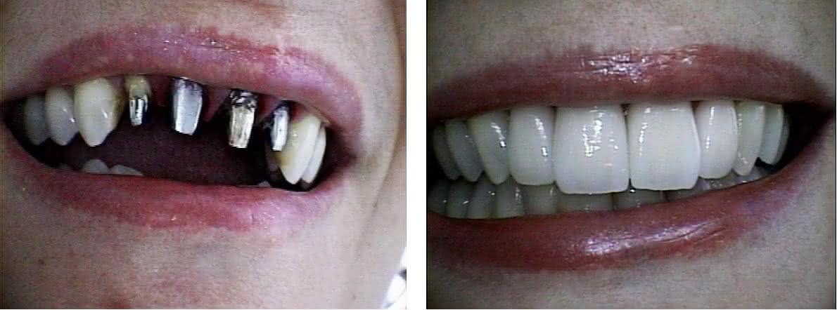 Implante Dentário de Porcelana
