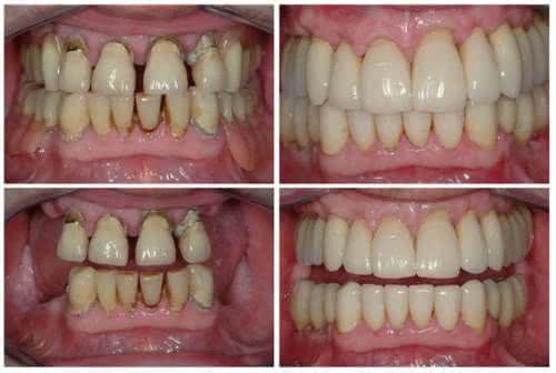 Implante Dentário Antes e Depois