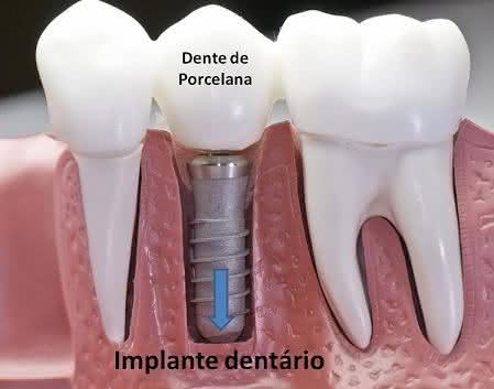 Implante Dentário Zigmático