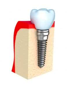 Implante dentário hexágono externo