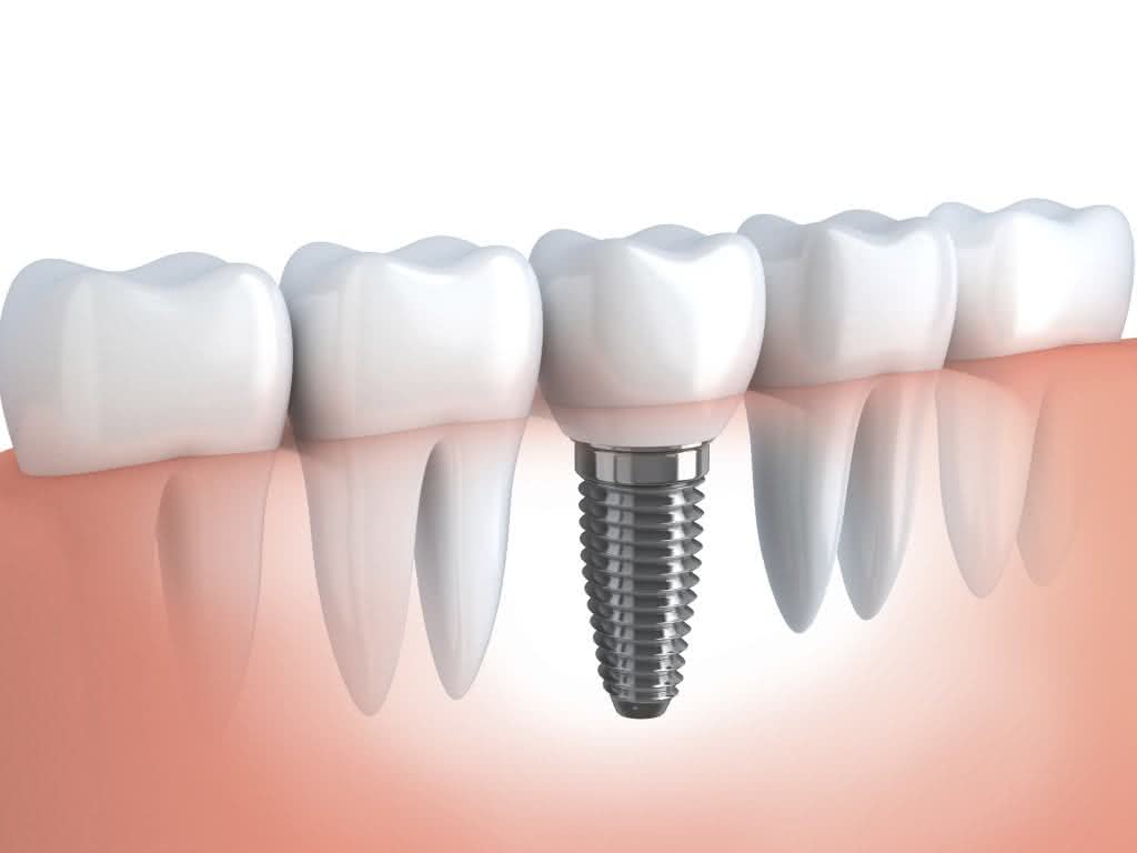 Implante Dentário Leva Ponto