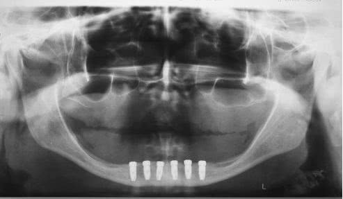 Rejeição do Implante Dentário