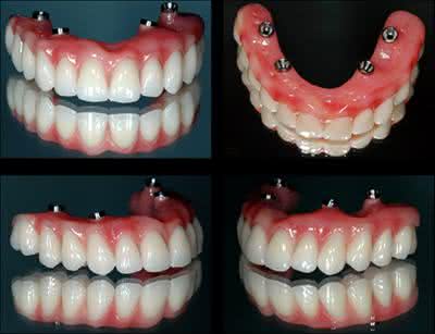 Implante Dentario Superior e Inferior