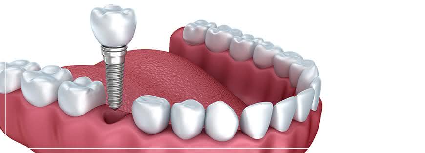 implante dentario