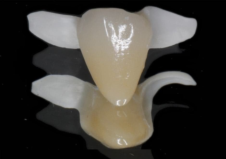 Prótese Adesiva Dentária Preço, Passo a Passo e mais Aparador De Ferro Para Sala ~ Prótese Adesiva Dentária Preço, Passo a Passo e mais