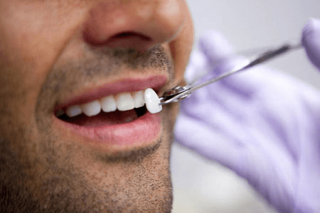Lentes de Contato para os Dentes