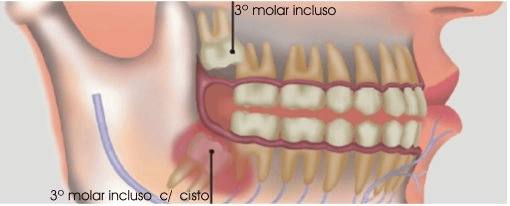O que são dentes do siso?