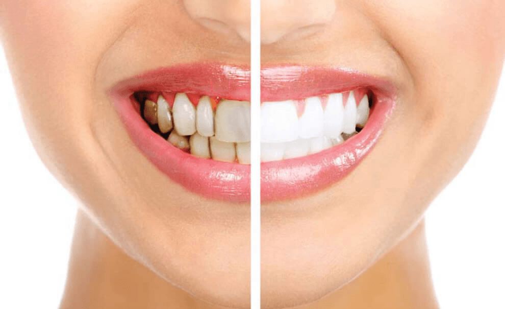 Dentes Amarelados: Pode ser alguma doença?