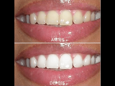 Clareamento Dental Caseiro
